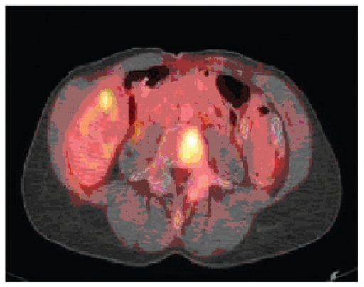 Documentation of complete response in metastatic breast cancer to liver and bone achieved with trastuzumab and pegylated liposomal Doxorubicin.