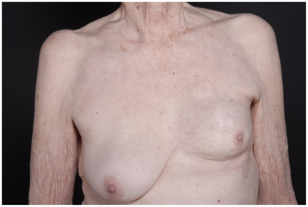 Response of cutaneous metastases from breast cancer to capecitabine.