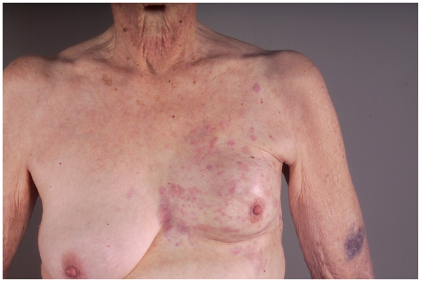 Response of cutaneous metastases from breast cancer to capecitabine.