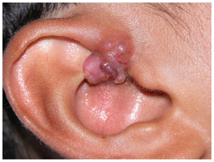 Unusual malignant transformation of recurrent sebaceoma. A case report.