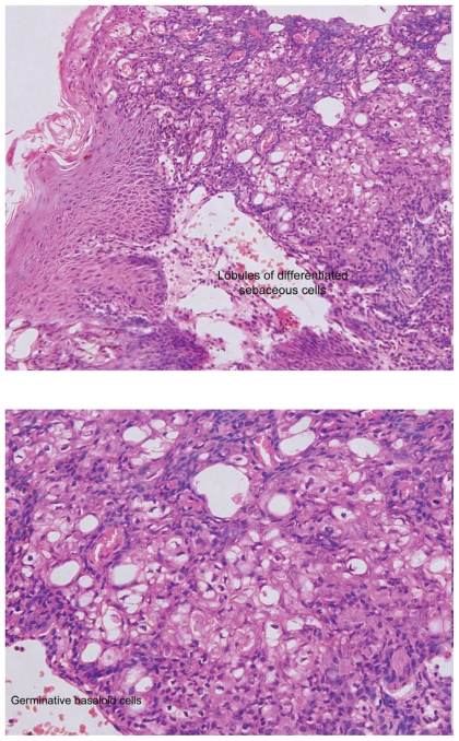 Unusual malignant transformation of recurrent sebaceoma. A case report.