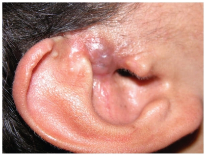 Unusual malignant transformation of recurrent sebaceoma. A case report.