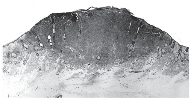 Atypical fibroxanthoma.