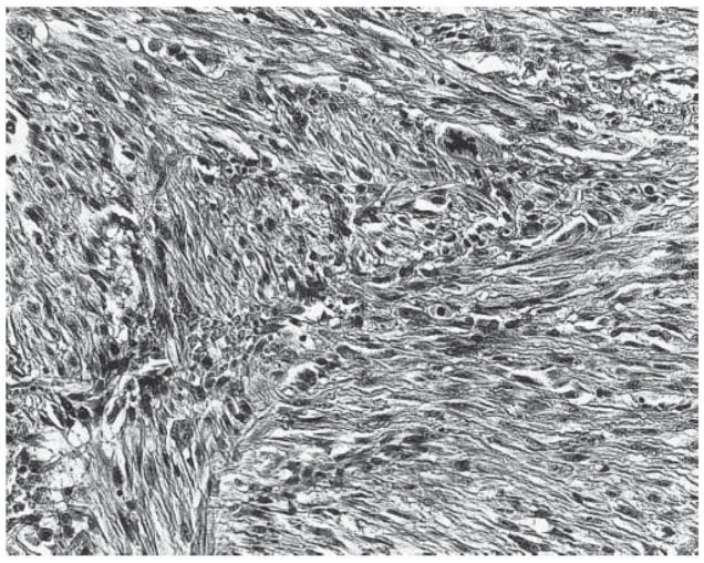 Atypical fibroxanthoma.