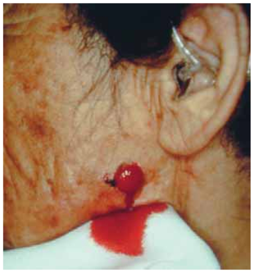 Atypical fibroxanthoma.