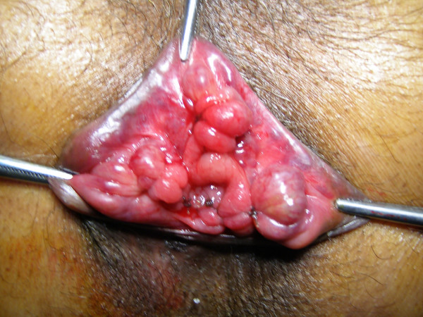 Ligation and mucopexy for prolapsing hemorrhoids--a ten year experience.