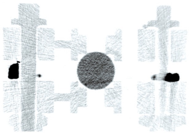 A Low-Cost Fiducial Reference Phantom for Computed Tomography.