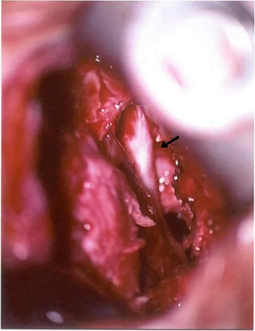 Safety of carboxymethylcellulose/polyethylene oxide for the prevention of adhesions in lumbar disc herniation--consecutive case series review.