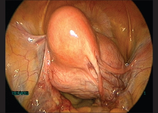 Total laparoscopic hysterectomy for large uterus.