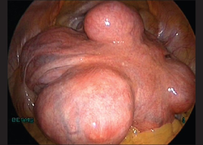 Total laparoscopic hysterectomy for large uterus.