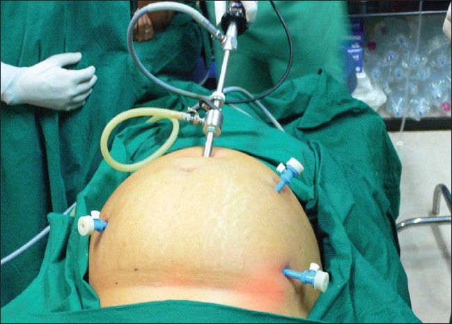 Total laparoscopic hysterectomy for large uterus.