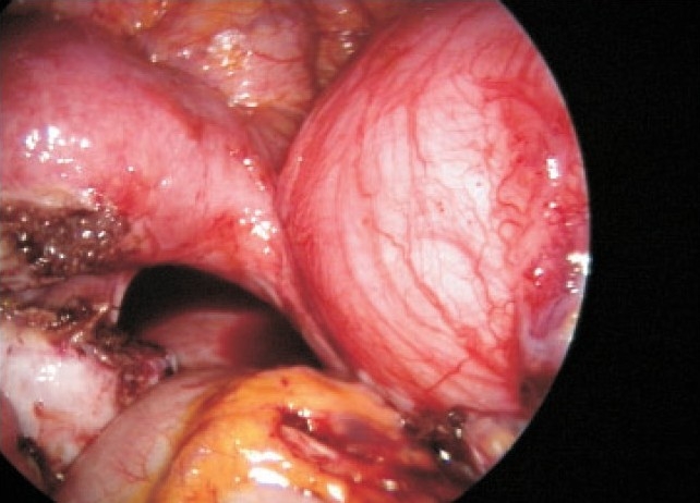 Unusual laparoscopy finding with previous laparotomy for endometrioma: a rare case report.