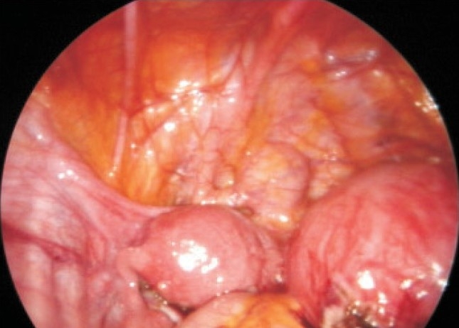 Unusual laparoscopy finding with previous laparotomy for endometrioma: a rare case report.
