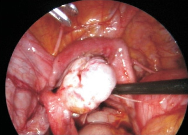 Unusual laparoscopy finding with previous laparotomy for endometrioma: a rare case report.