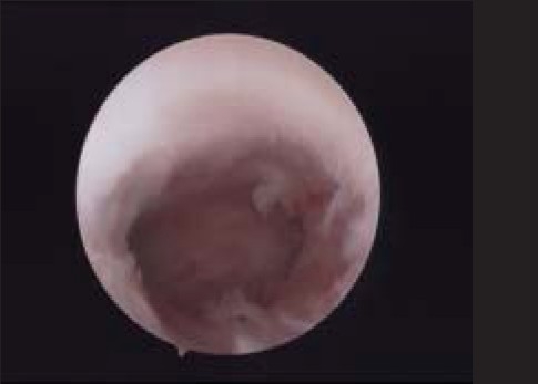 Reproductive performance after hysteroscopic metroplasty in women with primary infertility and septate uterus.
