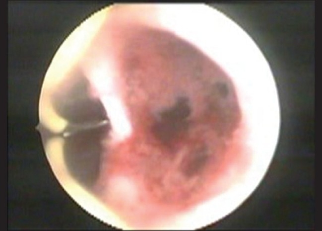 Reproductive performance after hysteroscopic metroplasty in women with primary infertility and septate uterus.