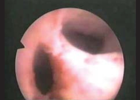 Reproductive performance after hysteroscopic metroplasty in women with primary infertility and septate uterus.