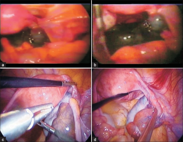 Detorsion and conservative therapy for twisted adnexa: our experience.