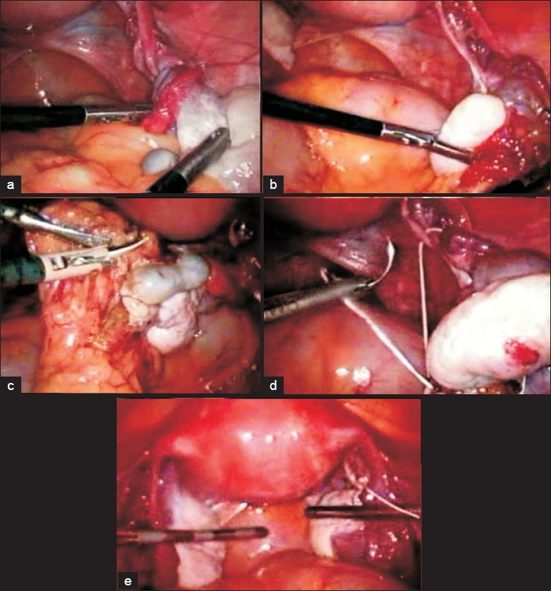 Detorsion and conservative therapy for twisted adnexa: our experience.