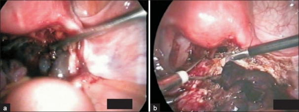 Detorsion and conservative therapy for twisted adnexa: our experience.