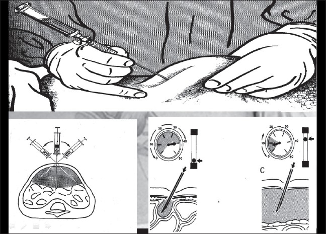 Entry complications in laparoscopic surgery.