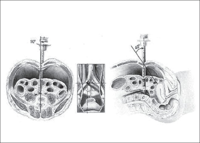 Entry complications in laparoscopic surgery.