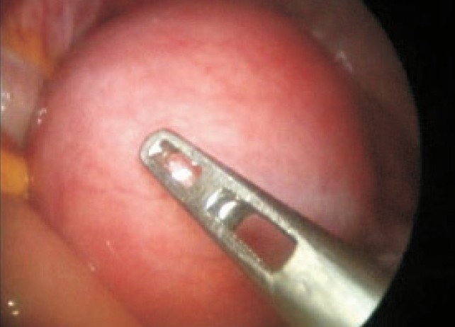 Predisposing factors for fibroids and outcome of laparoscopic myomectomy in infertility.