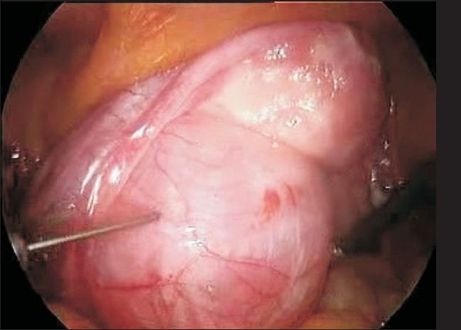 Predisposing factors for fibroids and outcome of laparoscopic myomectomy in infertility.