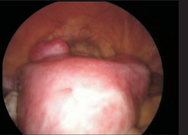 Predisposing factors for fibroids and outcome of laparoscopic myomectomy in infertility.