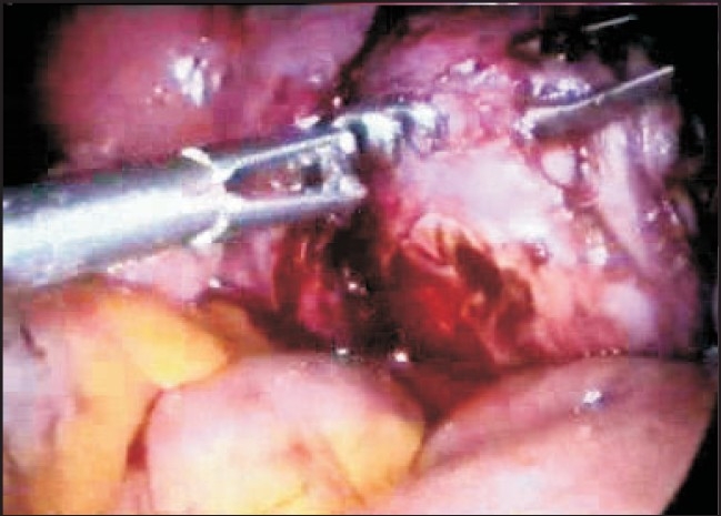 Comparison of Complications Rates in Endoscopic Surgery Performed by a Clinical Assistant vs. An Experienced Endoscopic Surgeon.
