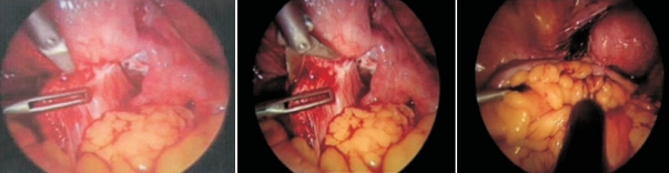 Large bowel injury during total laparoscopic hysterectomy.