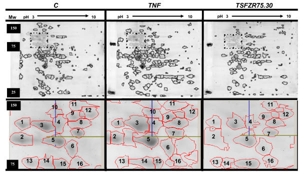 Glycosylated VCAM-1 isoforms revealed in 2D western blots of HUVECs treated with tumoral soluble factors of breast cancer cells.