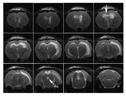 Intraventricular infusion of hyperosmolar dextran induces hydrocephalus: a novel animal model of hydrocephalus.