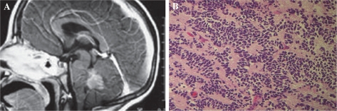 Treatment of early childhood medulloblastoma by postoperative chemotherapy alone-a critical review.