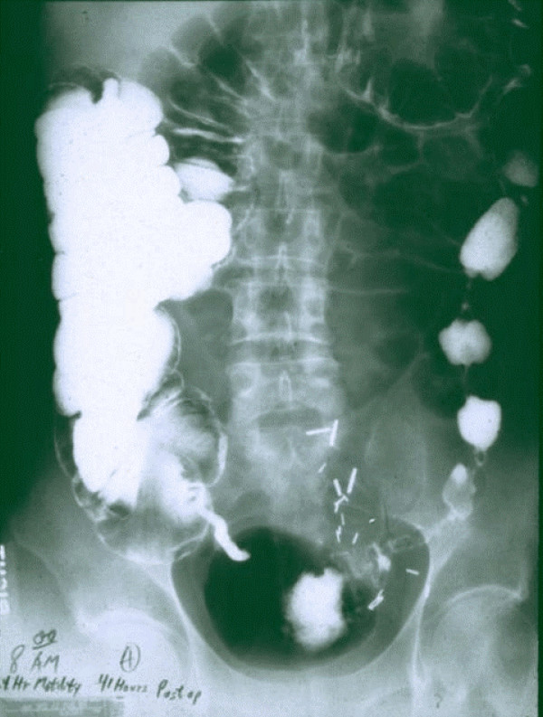 The etiology and prevention of feeding intolerance paralytic ileus--revisiting an old concept.