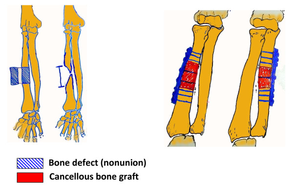 Outcome of diaphyseal forearm fracture-nonunions treated by autologous bone grafting and compression plating.