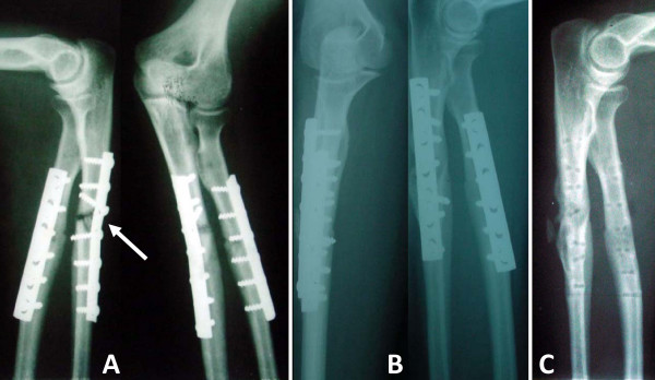 Outcome of diaphyseal forearm fracture-nonunions treated by autologous bone grafting and compression plating.