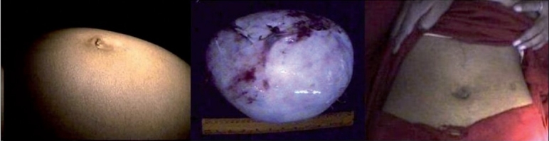 Laparoscopic management of large ovarian cysts at a rural hospital.