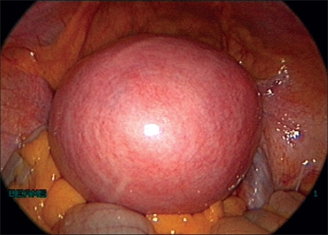 Laparoscopic management of large myomas.