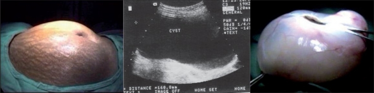 Laparoscopic management of large ovarian cysts at a rural hospital.