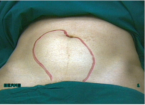 Laparoscopic management of large myomas.