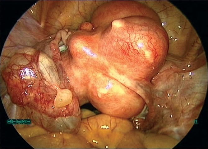 Laparoscopic management of large myomas.