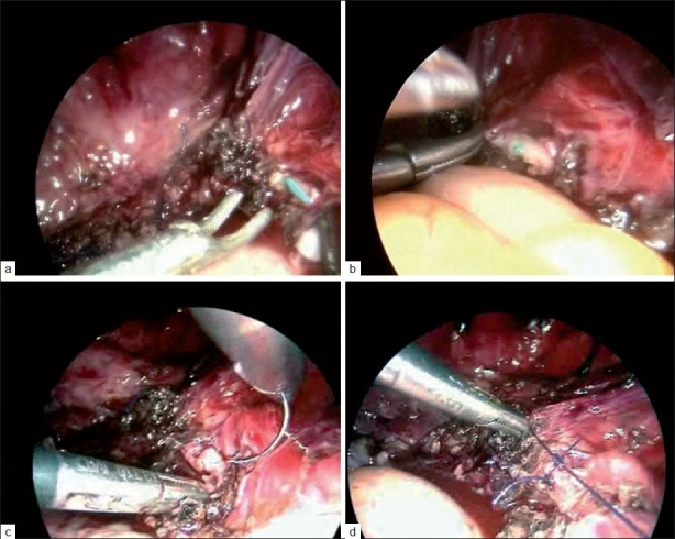 Do new vessel sealing devices and harmonic ace increase ureteric injury in total laparoscopic hysterectomy?