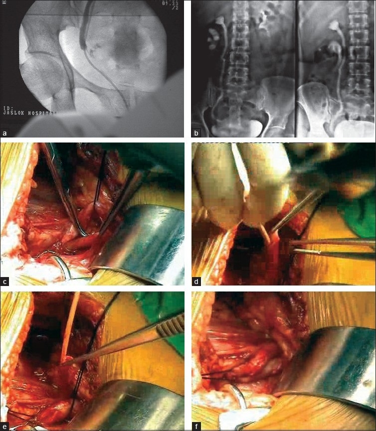 Do new vessel sealing devices and harmonic ace increase ureteric injury in total laparoscopic hysterectomy?