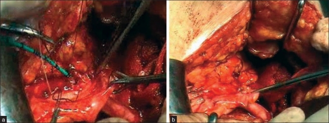Do new vessel sealing devices and harmonic ace increase ureteric injury in total laparoscopic hysterectomy?