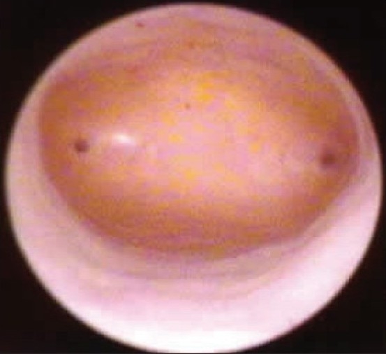 Hysteroscopy in postmenopausal bleeding.