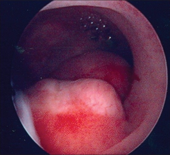 Hysteroscopy in postmenopausal bleeding.