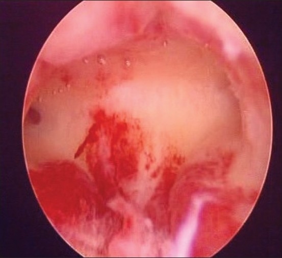 Hysteroscopy in postmenopausal bleeding.