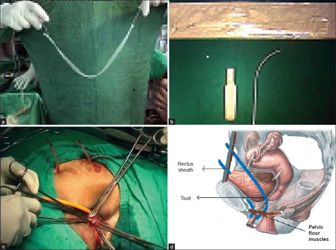 A Comparative Evaluation of Suburethral and Transobturator Sling in 209 Cases with Stress Urinary Incontinence in 8 years.