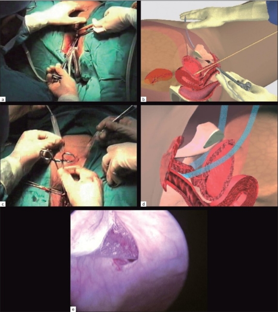 A Comparative Evaluation of Suburethral and Transobturator Sling in 209 Cases with Stress Urinary Incontinence in 8 years.